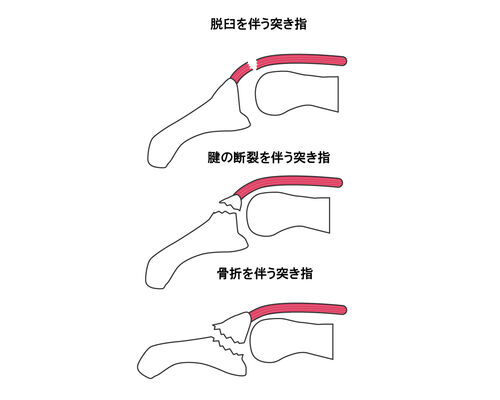イラストACマレットフィンガー