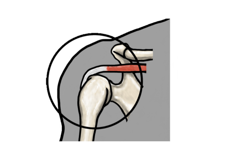 イラストAC腱板