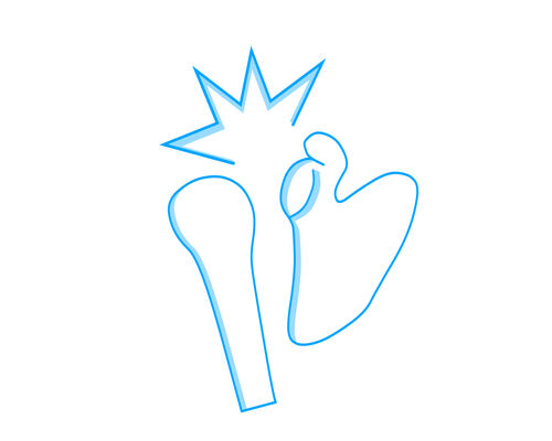 イラストＡＣ脱臼