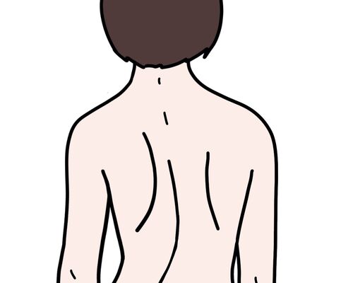 イラストＡＣ側彎症1