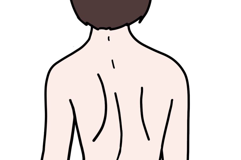 イラストＡＣ側彎症1