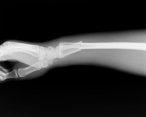 骨折レントゲン2