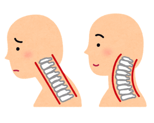 ストレートネック