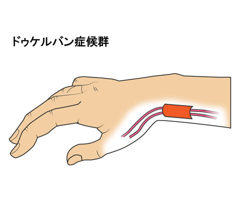 イラストACドケルバン