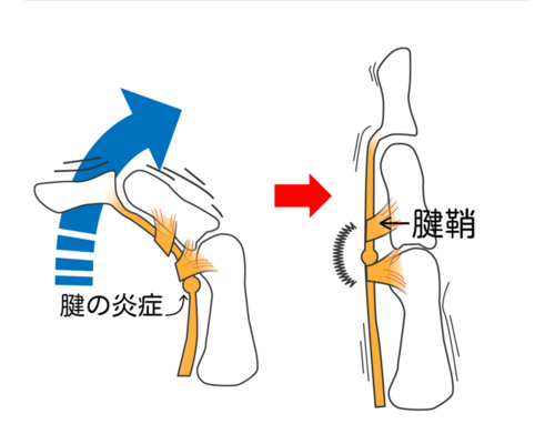 イラストACばね指