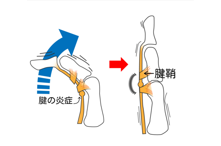 イラストACばね指